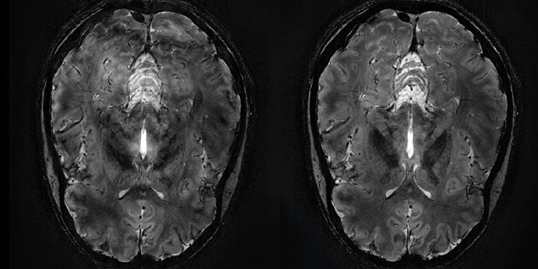 Vergr?sserte Ansicht:  Im Vergleich: Das MRI-Bild ohne die Verwendung einer Dynamic Field Kamera mit einigen Bildstörungen (links) und ein im Nachhinein korrigiertes Bild unter der Verwendung der neuen Kamera (rechts). (Bild: Skope)