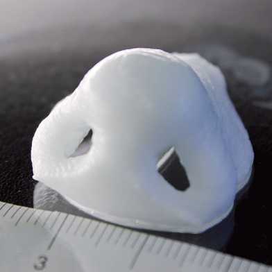 Nasentransplantat aus dem 3-D-Drucker