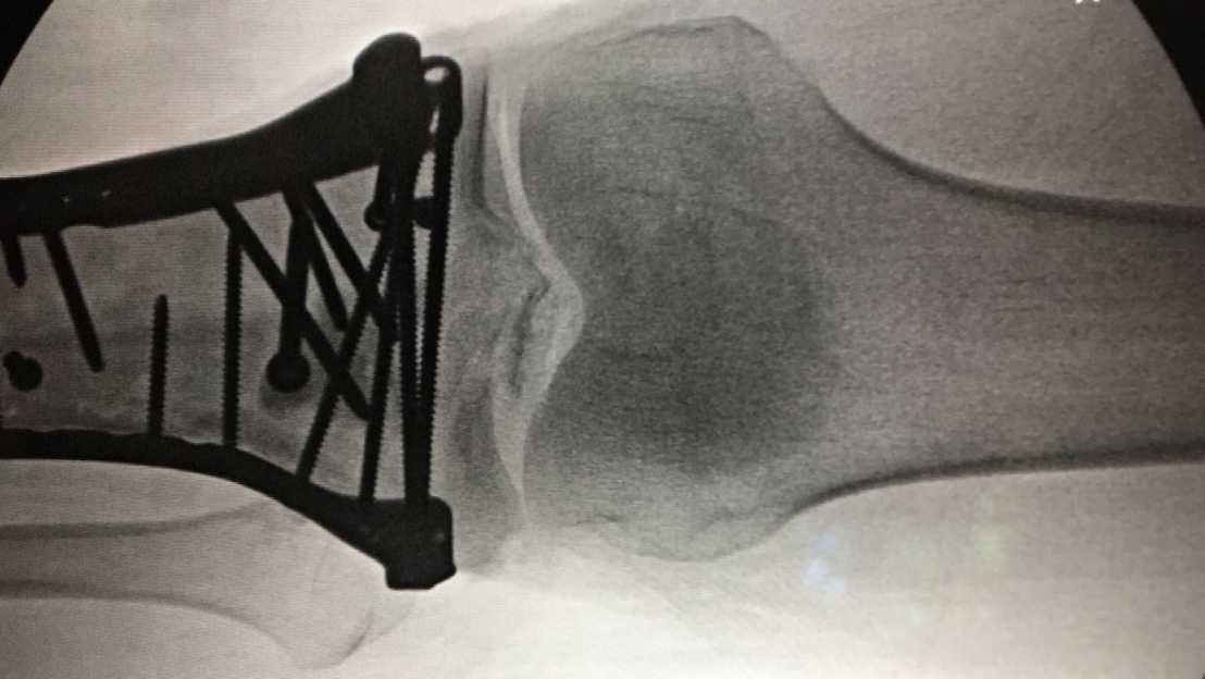 Vergr?sserte Ansicht: Röntgenbild eines Schienbeinbruchs direkt unterhalb des Kniegelenks: Solch komplizierten Verschraubungen sollen vereinfacht werden. (Bild zVg T. Zumbrunn)