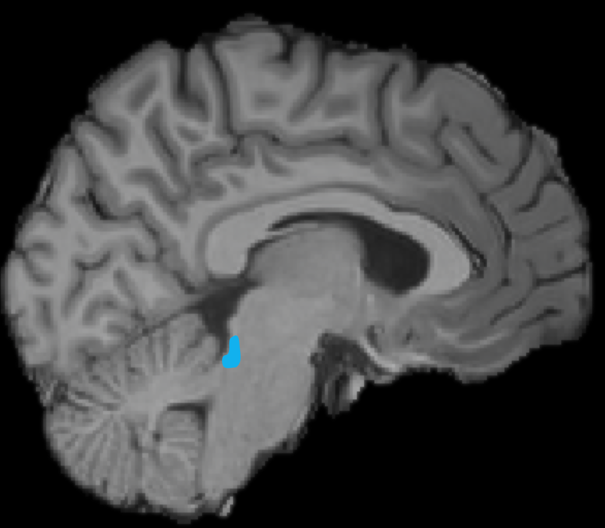 Vergr?sserte Ansicht: MRI von einem Gehirn, eine kleine Fläche (in der unteren Hirnhälfte in der Mitte) ist blau markiert